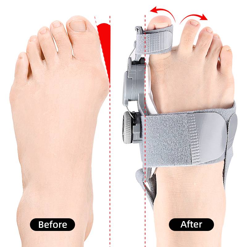 Adjustable Bunion Corrector with Twist Knob Control and Silicone Cushioning, Heel Strap